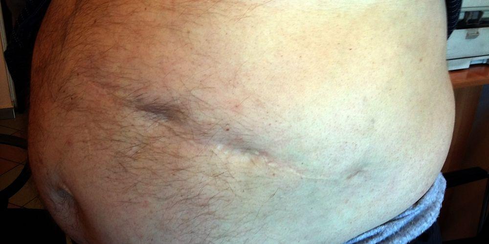 Po operacji sprzed 43 lat pozostała blizna. Fot. Z. Juśkiewicz - fot. 